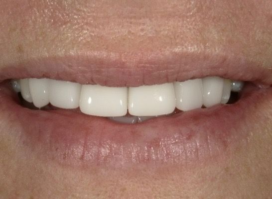 The Ultimate Guide to All-on-4 Dental Implants: Everything You Need to Succeed with Your Utah Smile Restoration